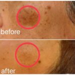 夏の紫外線ケア☆シミケアメニューでリセット！